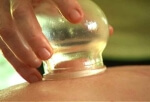 cupping with acupuncture.